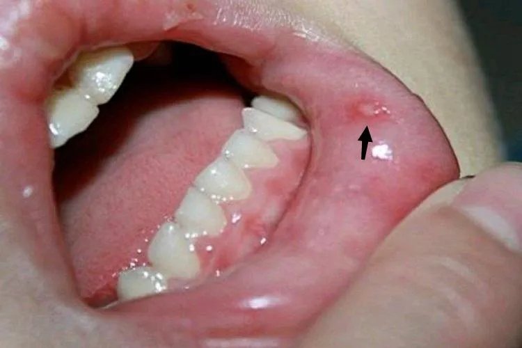 轻微手足口病嘴巴图片