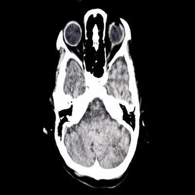 颅脑肿瘤分类有哪些