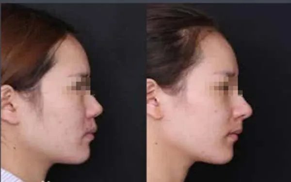 天津整形医院哪家做隆鼻好