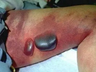 气性坏疽症状图片