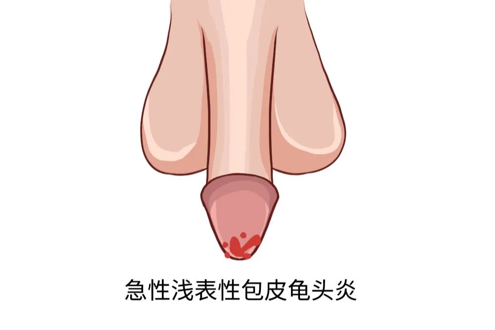 4种龟头炎图片