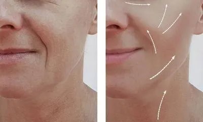 面部填充手术会怎么样