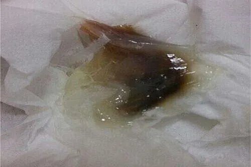 宫颈癌血性白带图片