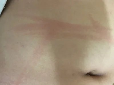 人工荨麻疹症状图片