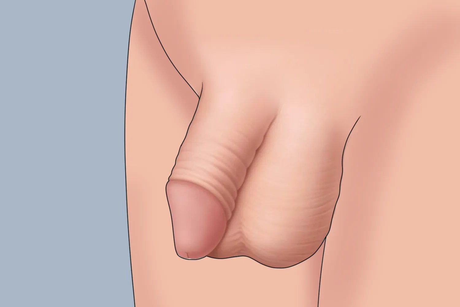 割包茎手术恢复过程图