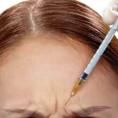 电波拉皮除皱术效果