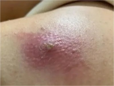 皮肤蝇蛆病症状图片