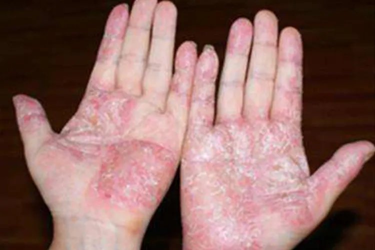 真菌性手癣图片