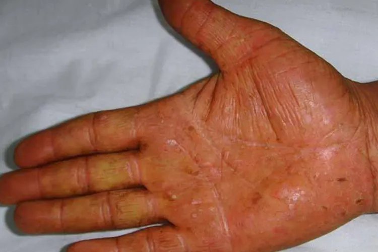 真菌性手癣图片