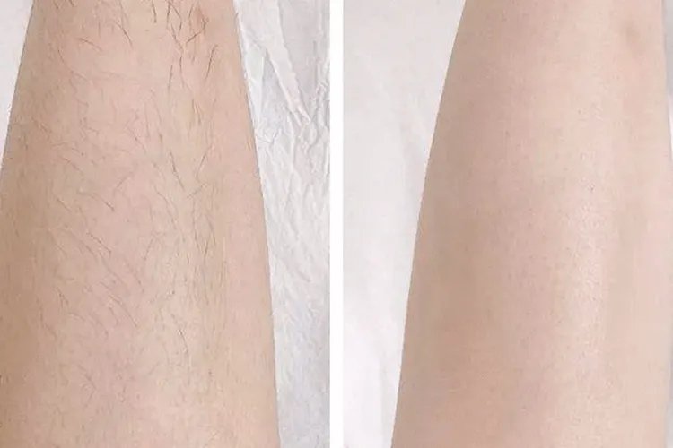脱毛图片效果