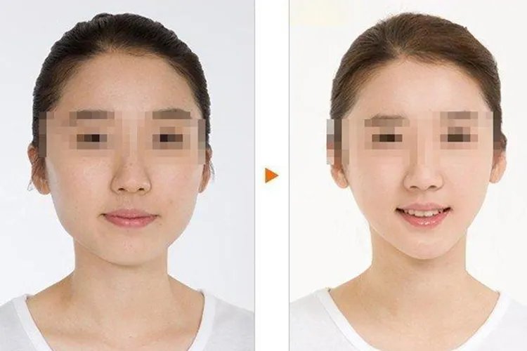 打瘦脸针的效果图