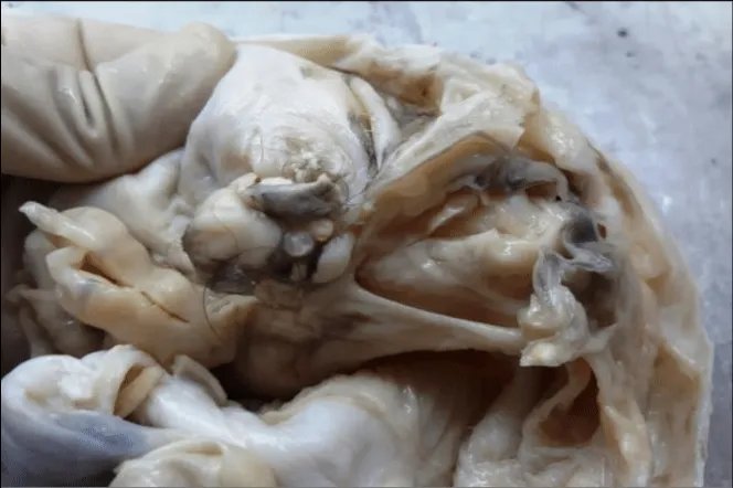 卵巢畸胎瘤图片