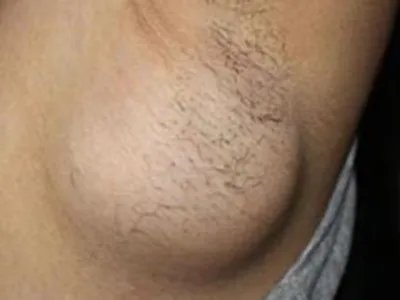 乳腺癌症状图片