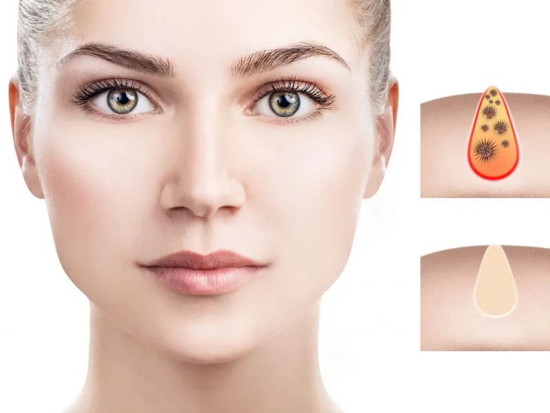 毛发上皮瘤是什么