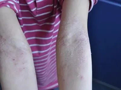 皮肤过敏红肿胳膊症状图片