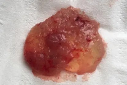 孕囊是块肉吗,掉下来的完整孕囊图片