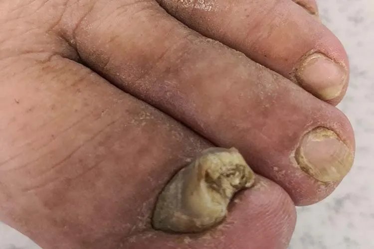 灰指甲是什么原因造成的图片