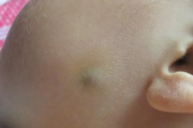 小孩子长粉瘤图片