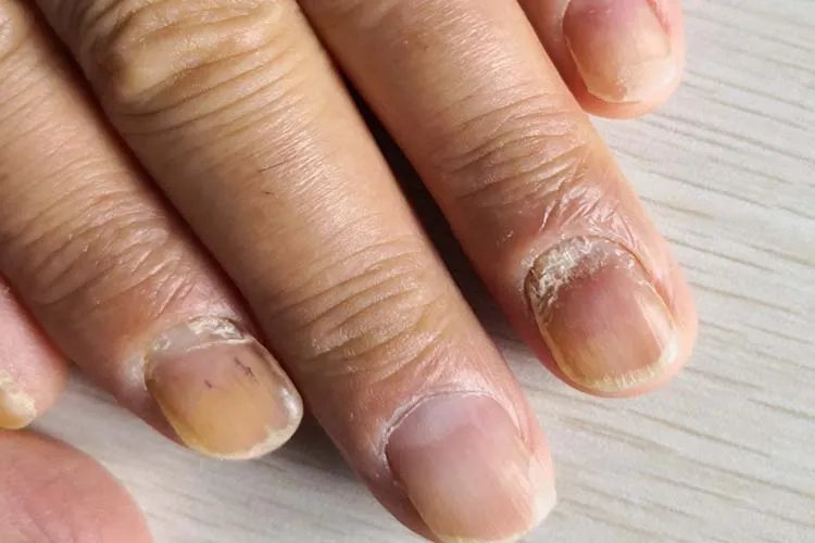 灰指甲是什么原因造成的图片