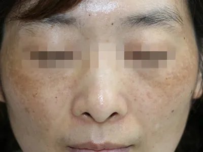 黄褐斑症状图片