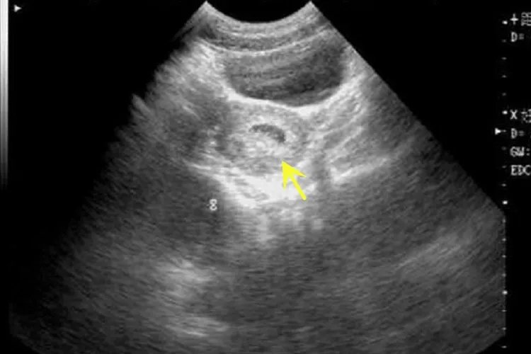 怀孕一个月宝宝在哪个位置图