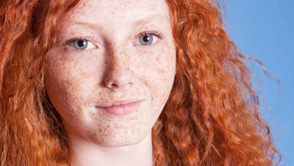 日晒斑怎么治疗