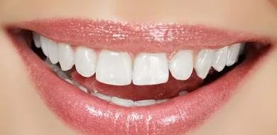 厦门种植牙要多少钱