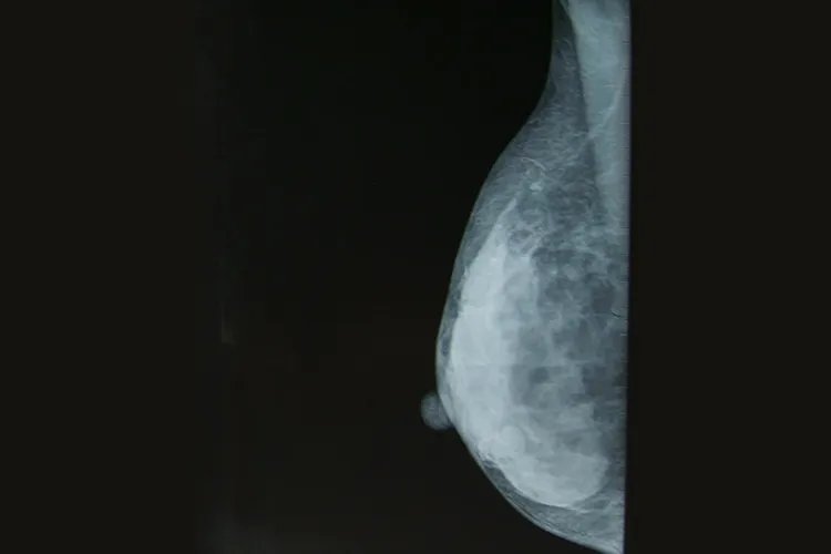 乳腺胸片照片