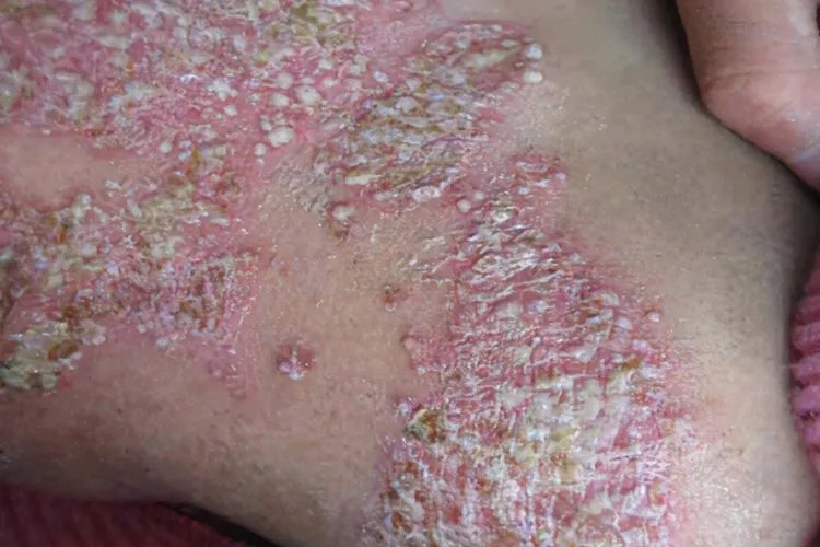 点滴状银屑病三个阶段图片