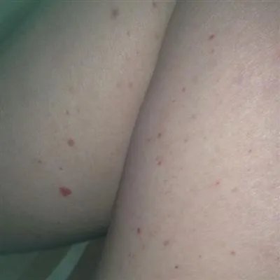 吃vb2后浑身搔痒是什么原因