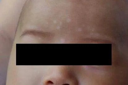 小孩汗癣症状图片