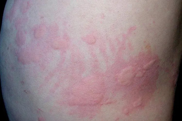 儿童螨虫过敏症状图片