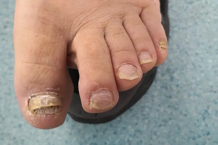 灰指甲早期症状图