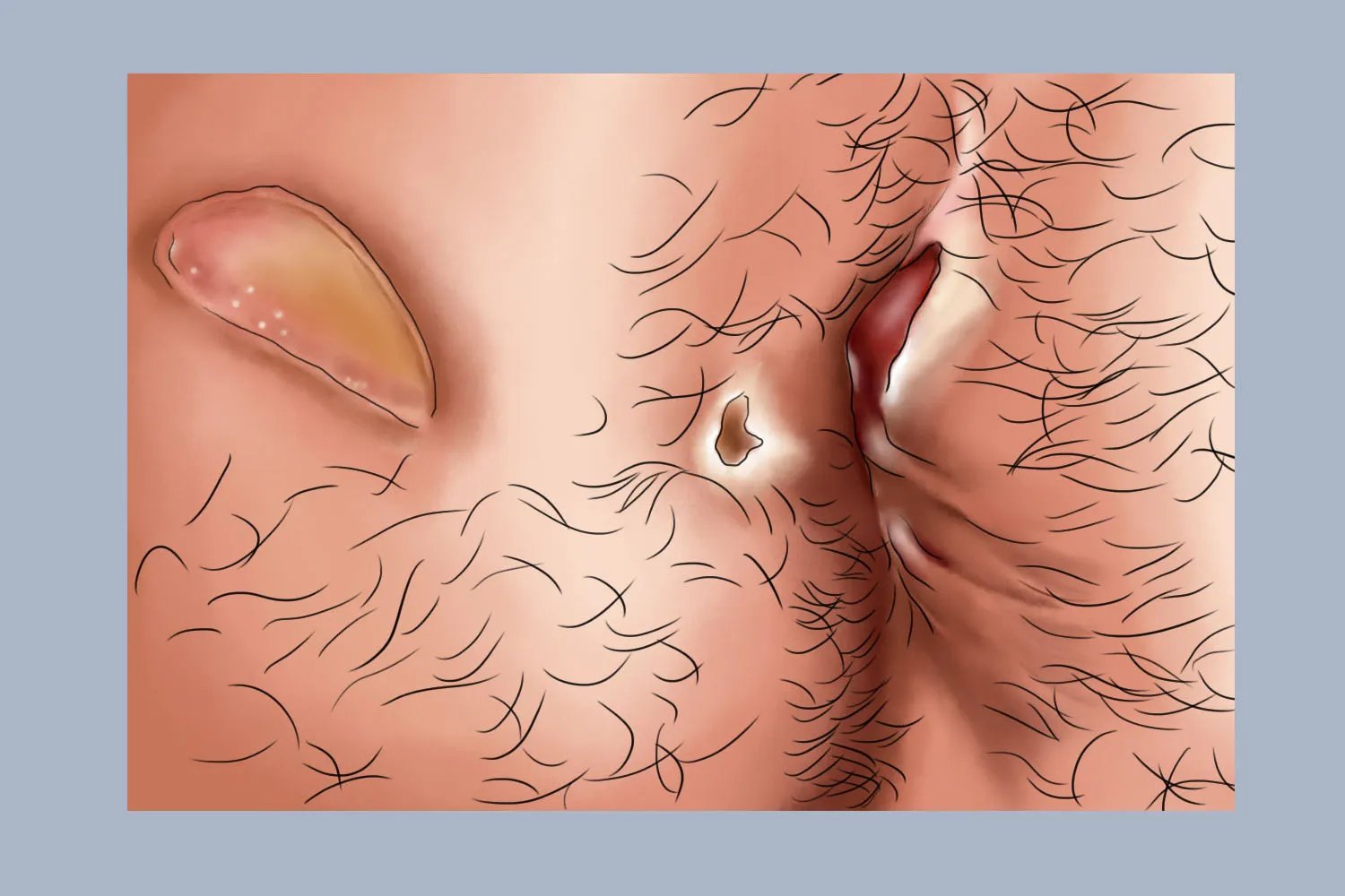 微创肛瘘手术伤口真实图片