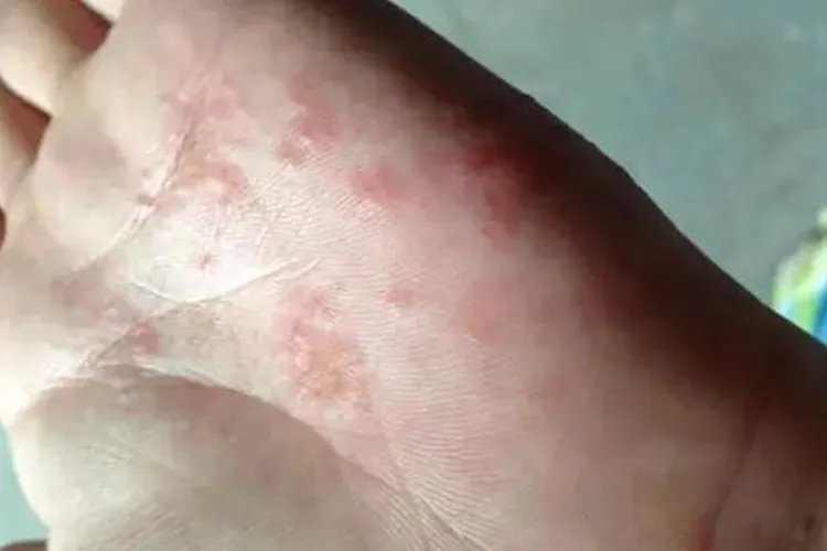 皮丘疹图片大全