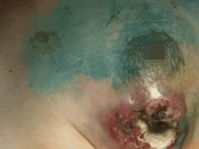 乳腺癌症状图片