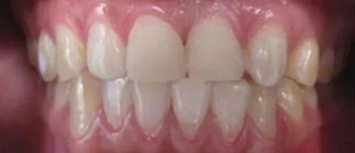 北京种植牙一颗多少钱