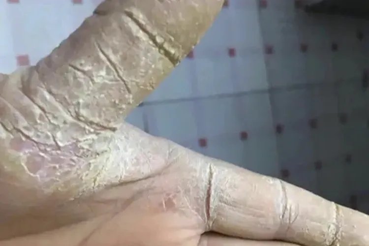 鹅掌风手癣图片