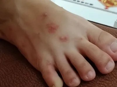 跳蚤叮咬疙瘩图片
