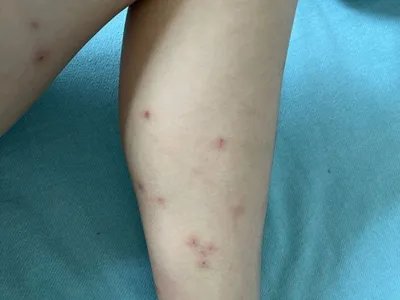 跳蚤叮咬疙瘩图片