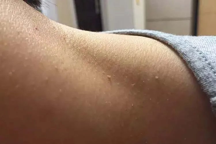 脖子上长肉刺图片