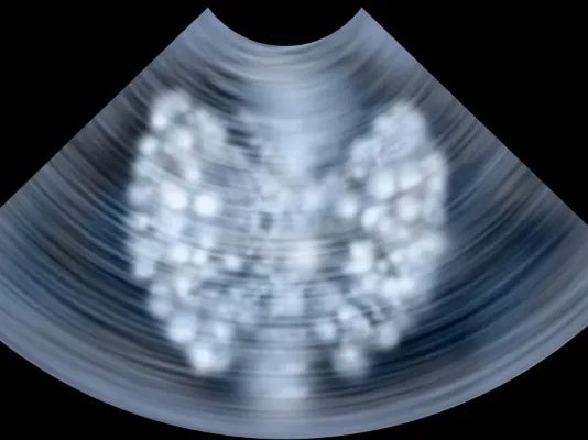 消化道溃疡如何治疗