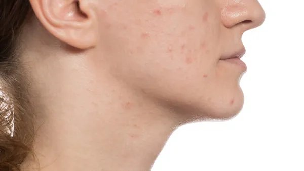 右边脸颊长痘是什么原因