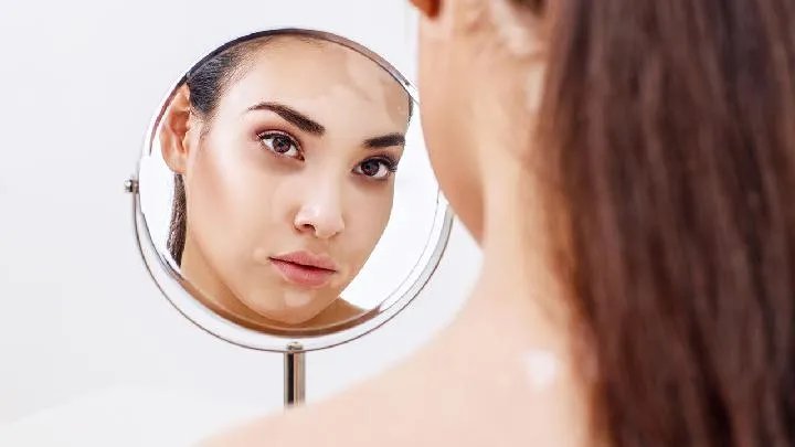 白癜风中医治疗方法有哪些