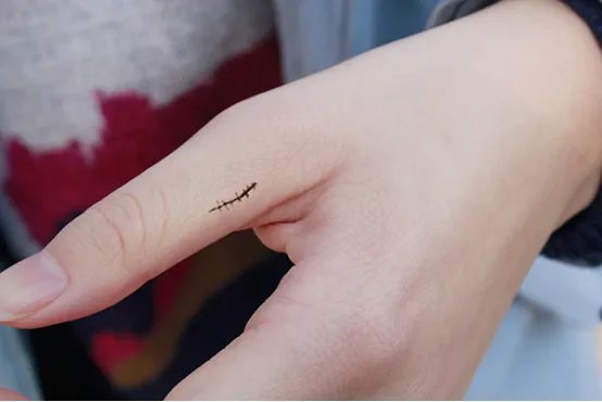 撕裂伤口怎么处理