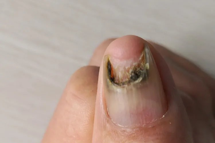 灰指甲早期症状图