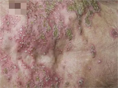 皮肤蝇蛆病症状图片