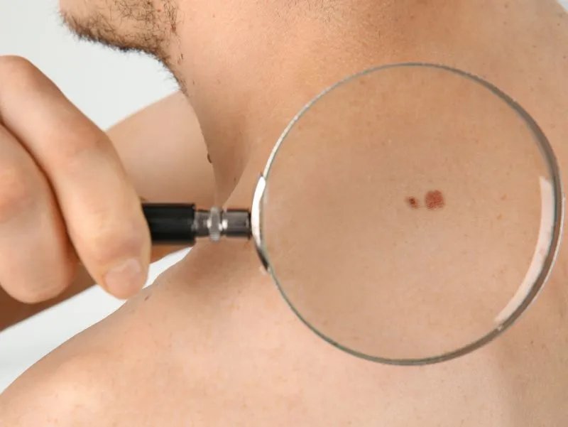 身体长肉芽是什么原因