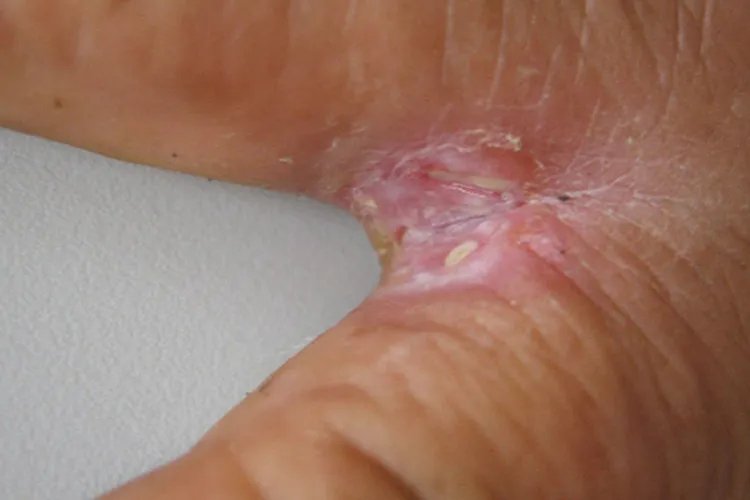 鹅掌风手癣图片