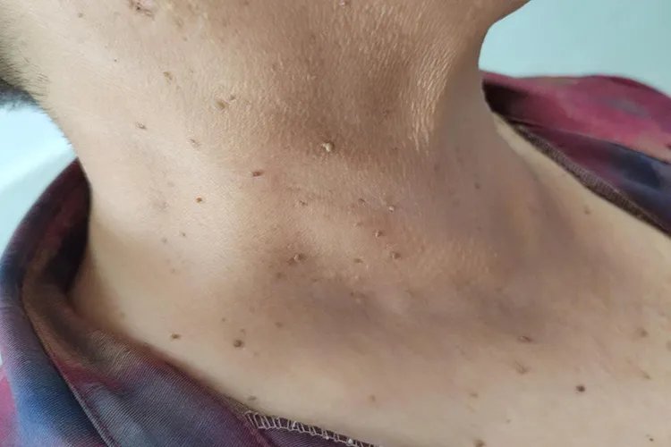 脖子上长肉刺图片
